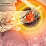 Bauchspeicheldrüsenkrebs, bösartiger Tumor der Bauchspeicheldrüse, 3D-Darstellung ©shutterstock.com Kateryna Kon 